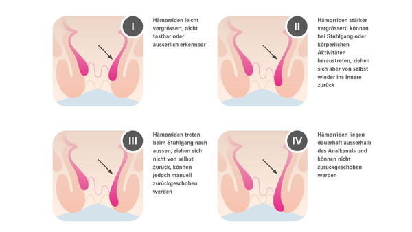 4 Schweregrade bei Hämorrhoiden